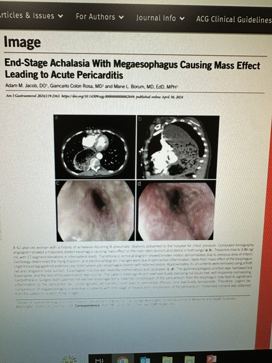 Great job on this case write up <a href="/AdamMJacob/">Adam M. Jacob, DO</a> and co-authors!! <a href="/GWSMHS/">GW SMHS</a> <a href="/AmCollegeGastro/">ACG</a> <a href="/AmJGastro/">AJG - The American Journal of Gastroenterology</a>