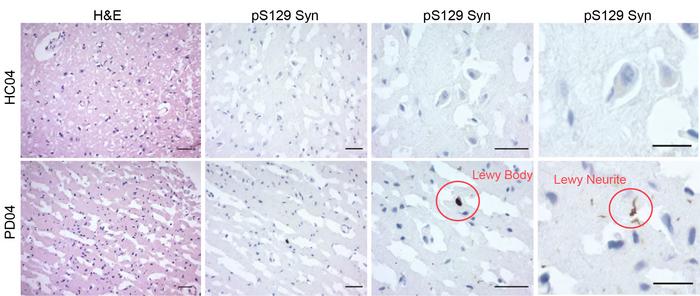 Science Translational Medicine (@sciencetm) on Twitter photo A #SingleCell analysis of the brain during #ParkinsonsDisease provides a valuable cellular “catalogue” of the transcriptional and #proteomic landscape, and could inform future research and therapeutic testing. <a href="/ysphbiostat/">Yale Biostatistics</a> <a href="/lesleylezhang/">Le Zhang</a> <a href="/SChandraLab/">Chandra Lab</a> bit.ly/40rW5Sx A #SingleCell analysis of the brain during #ParkinsonsDisease provides a valuable cellular “catalogue” of the transcriptional and #proteomic landscape, and could inform future research and therapeutic testing. <a href="/ysphbiostat/">Yale Biostatistics</a> <a href="/lesleylezhang/">Le Zhang</a> <a href="/SChandraLab/">Chandra Lab</a> bit.ly/40rW5Sx