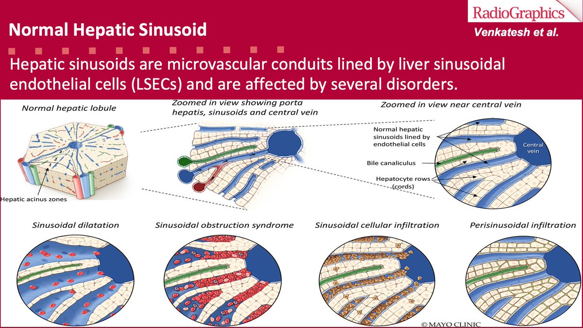 sbastawrous1's tweet photo. The primary manifestations of sinusoidal disorders are circulatory changes, specifically alteration of sinusoidal blood flow. 2/9
#RGphx #GIRad
@cookyscan1
@Radiographics https://t.co/dOG6qZBV3s