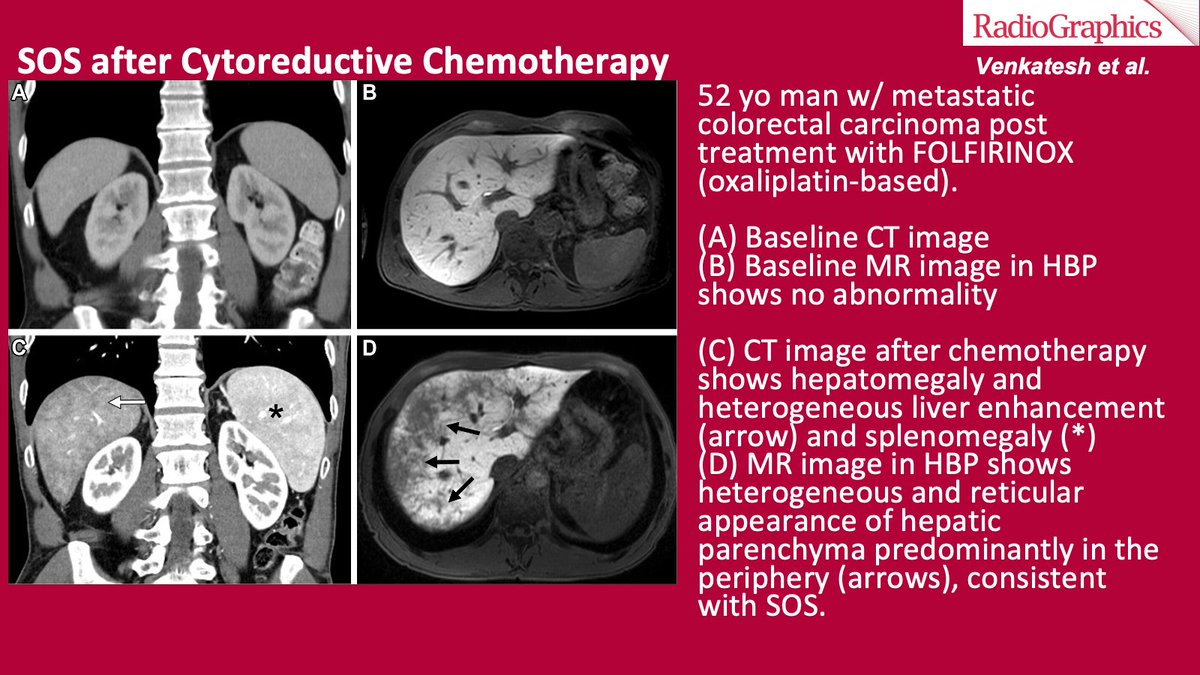 sbastawrous1's tweet photo. Oxaliplatin is a known cause of SOS. Patients with SOS after cytoreductive chemotherapy may be asymptomatic or have mildly elevated serum liver enzymes. Imaging indicates characteristic findings even when SOS is subclinical. 6/9
#RGphx #GIRad
@cookyscan1
@Radiographics https://t.co/uMlCalSTJH