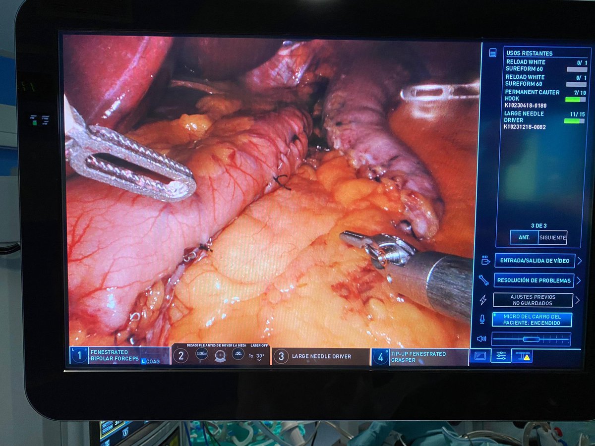 Víctor Valentí (@doctorvalenti) on Twitter photo Inicio del programa formativo en cirugía bariatrica robótica para residentes <a href="/cun_surgery/">CUN Surgery</a> <a href="/ClinicaNavarra/">Clínica Universidad de Navarra</a>
Enhorabuena <a href="/NuriaBlancoa/">Nuria</a>
Bienvenida doble consola <a href="/abexDaVinci/">ABEX Excelencia Robótica</a> Inicio del programa formativo en cirugía bariatrica robótica para residentes <a href="/cun_surgery/">CUN Surgery</a> <a href="/ClinicaNavarra/">Clínica Universidad de Navarra</a>
Enhorabuena <a href="/NuriaBlancoa/">Nuria</a>
Bienvenida doble consola <a href="/abexDaVinci/">ABEX Excelencia Robótica</a>