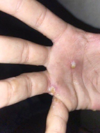 yazanomarrr's tweet photo. I BEG U , DONT IGNORE FOR IMPORTANCE

My brother and I have a bacterial infection and we suffer from stomach pain and chronic diarrhea due to water, air and unhealthy food contamination. Help us get help by donating, participating To save us🥹🙏🍉

https://t.co/AJXZJKwOsV https://t.co/j0uXTLb3QL