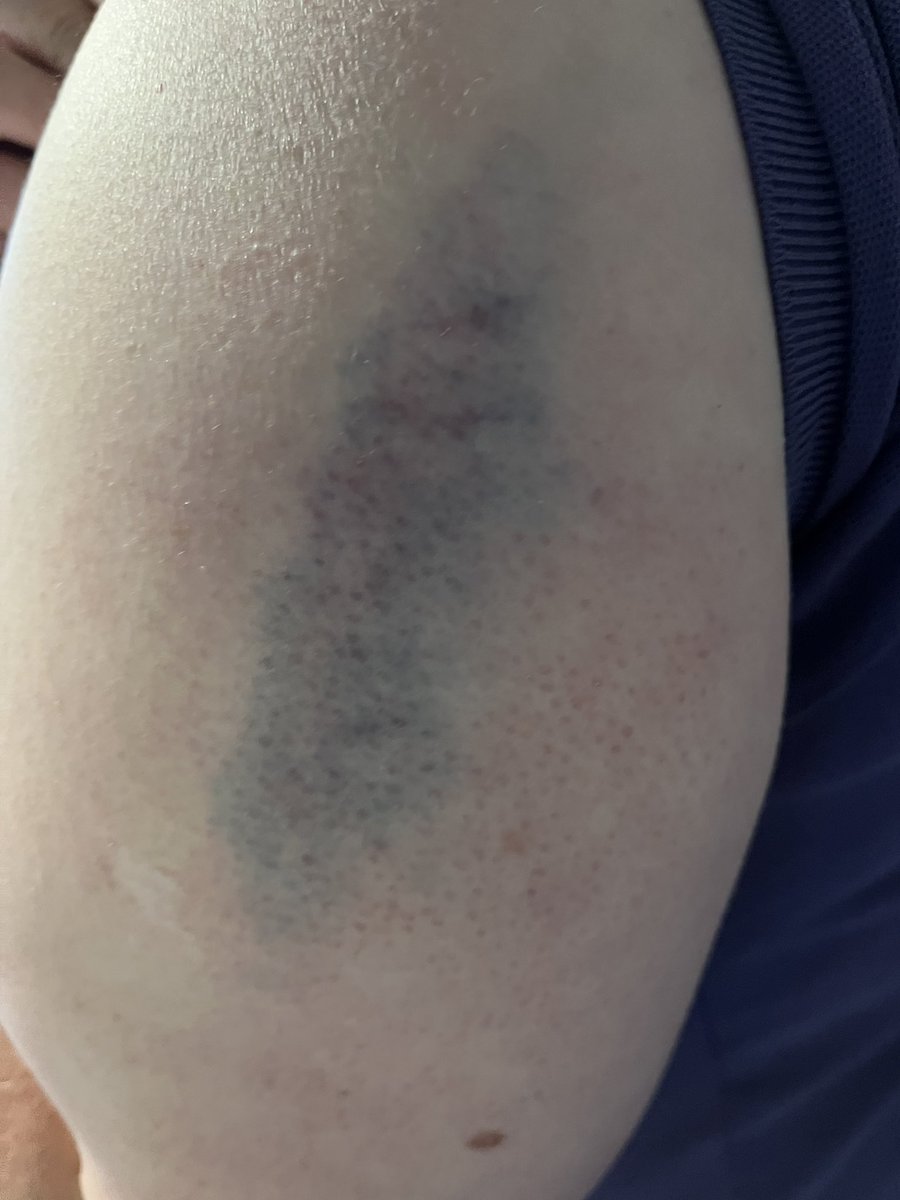 hockey_laura's tweet photo. Got a wee bit over invested in the laser tag yesterday, competitive nature kicked in, zooming about ran round a corner, straight into a wall….🙄🤦♀️😂 #tenpin #lasertag #bruisedarm https://t.co/W8OoVcUbOo