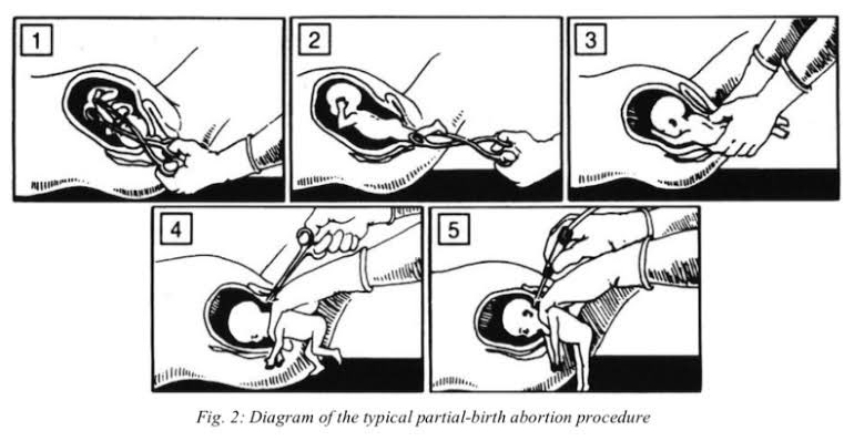 FridaEsp_'s tweet photo. 🚨Se aprobó el dictamen en comisiones que quita del código penal el delito del aborto en CDMX

Esto abre la puerta para quitar cualquier restricción de aborto, permitiéndolo incluso hasta los 9 MESES 

Se los dijimos, nunca iban a estar satisfechos 

Así se ve un aborto tardío https://t.co/lGnDGCcS4i