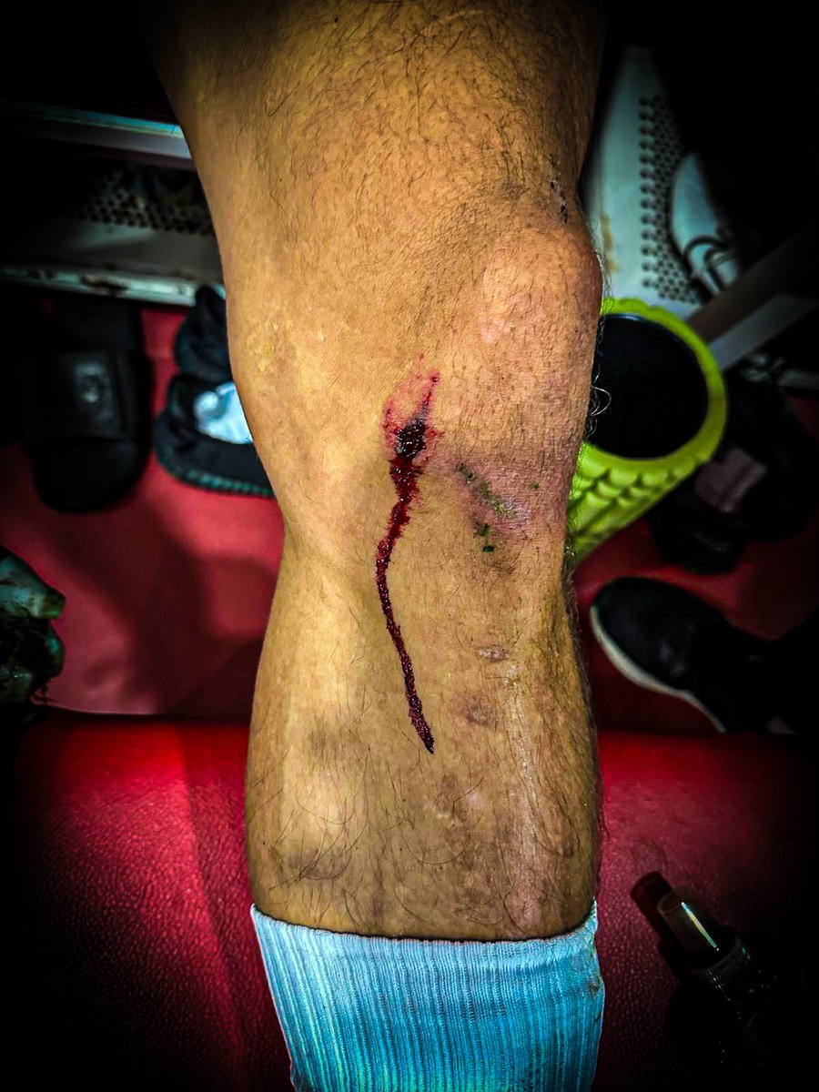 Bugün sahamızda oynanan müsabakada bir skandala daha imza atılmıştır.

Futbolcumuz Emre Kılınç’a yapılan şiddetli faul sonrasında, hakemin gözü önünde futbolcumuzun dizi kanlar içinde kalmış ve ardından açık penaltı olan bu pozisyon için hakem VAR’a başvurmuştur. Ancak, ilginç