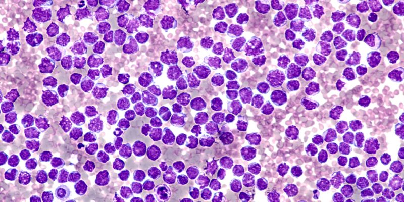 Anti-CD19 CAR-T therapy showed encouraging response rates in patients with #MCL with and without active CNS disease at infusion.

Read more from the study led by <a href="/gulrayzahmed/">Gulrayz Ahmed</a>, of <a href="/MedicalCollege/">Medical College of Wisconsin</a>, and published in <a href="/BloodAdvances/">Blood Advances</a>.

➡️ buff.ly/3Ys2vhJ