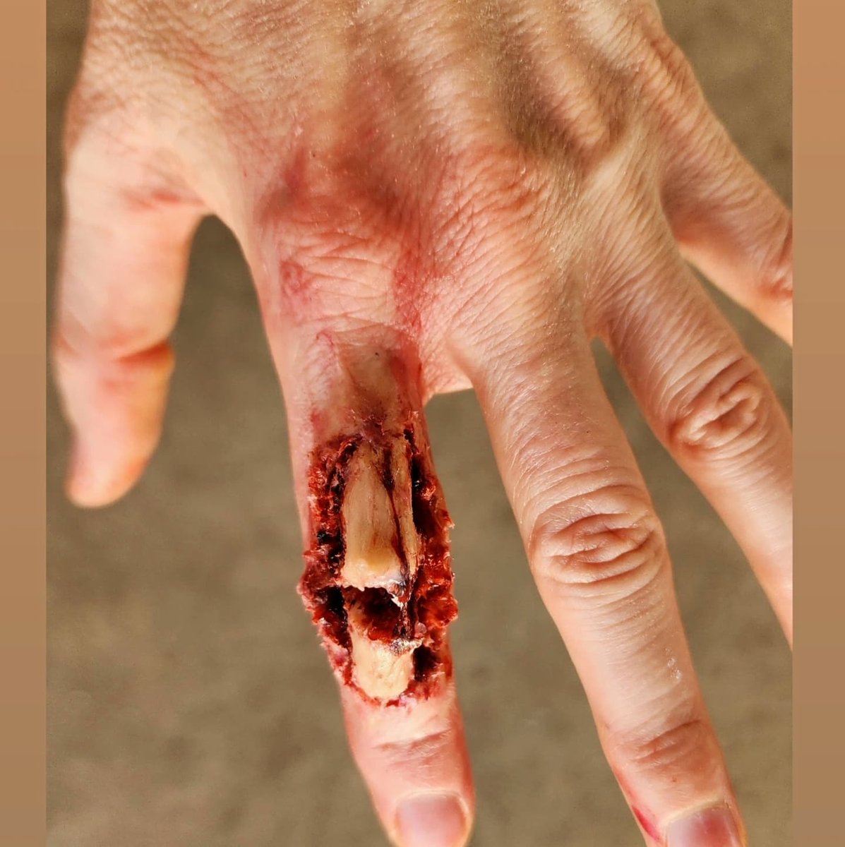 deabea5's tweet photo. Oh darling compound fracture, I could never quit you, regardless of what part of human anatomy you traumatise.

Light wasn't my lover today but I made do.
🤣 https://t.co/EqiYzMZxdk