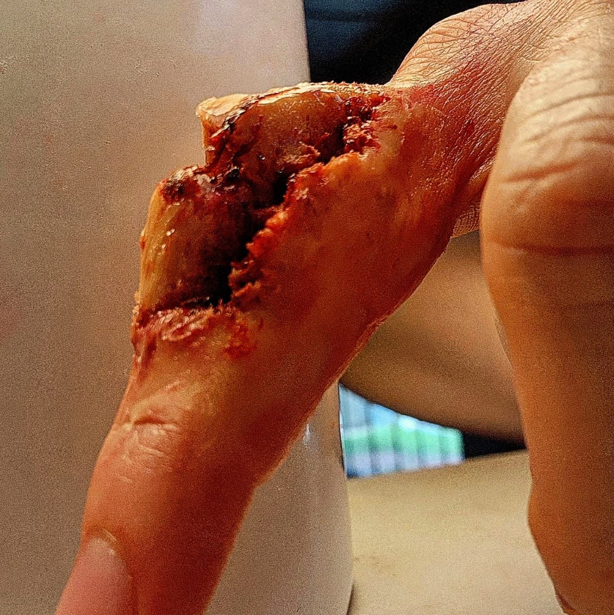 deabea5's tweet photo. Oh darling compound fracture, I could never quit you, regardless of what part of human anatomy you traumatise.

Light wasn't my lover today but I made do.
🤣 https://t.co/EqiYzMZxdk