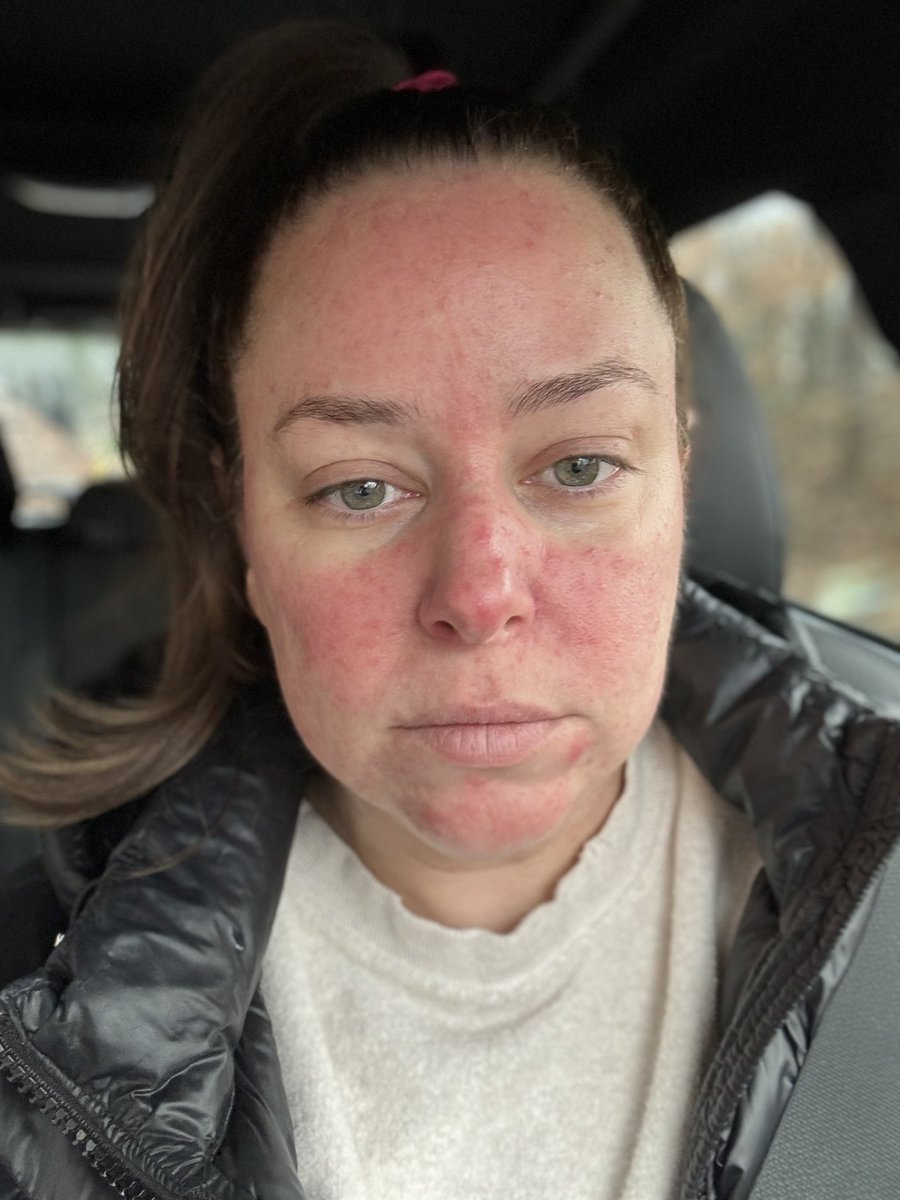 MegCFitz's tweet photo. @CilComLFC @Wejolyn My derm prescribed it to me after trying every topical and nothing would work. Changed my skin so quickly. Apparently insurance won’t cover the actual prescription unless trying every other topical first. You can see how miserable and uncomfortable I am in the first pic https://t.co/V0GgDVvd1D