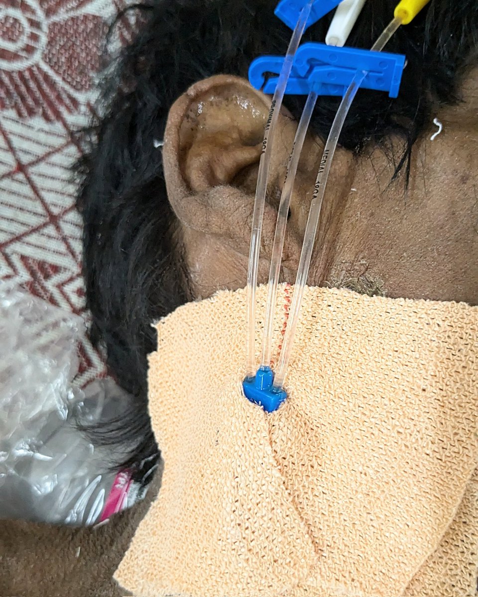 1st Central line is always special ✅

#MEDTwitter #surgery #medicalstudent