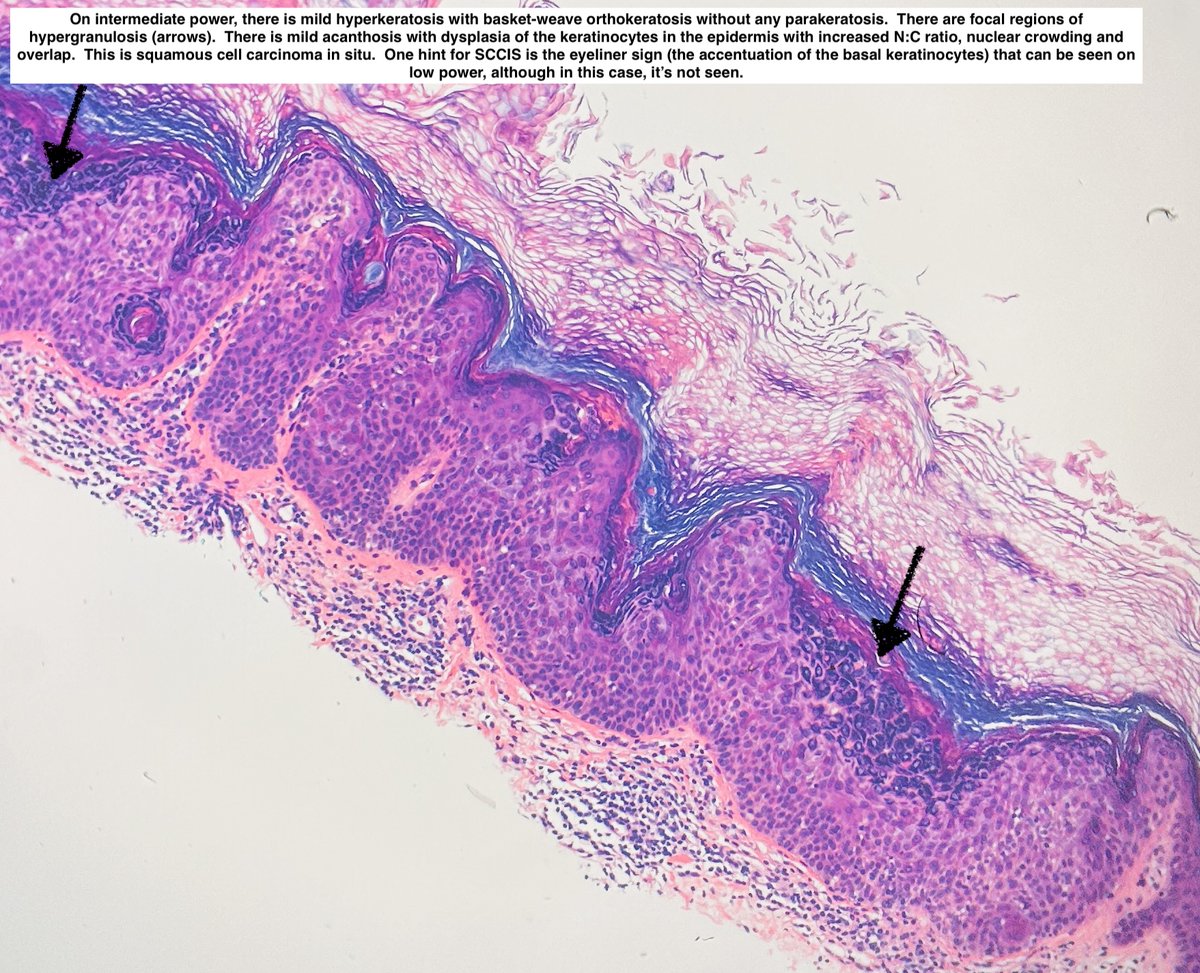 Squamous Cell Carcinoma In Situ 

⬇️ 

#pathx #histox #pathtwitter #dermpath #pathagonia #path4people