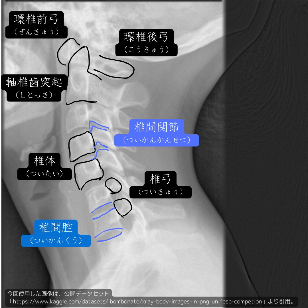 OpenCV_4's tweet image. 頸椎側面撮影➁

椎間腔（ついかんくう）と呼ばれる部位に、椎間板（ついかんばん）が含まれます。