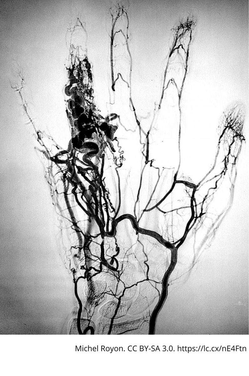 UBDivulga's tweet photo. Angiografia #voldir prova diagnòstica que es fa amb l’objectiu d’obtenir informació sobre els vasos sanguinis. Es realitza gràcies a la introducció d’un líquid de contrast per poder observar-les a temps real. #DiaMundialRadiologia https://t.co/ftfKI5Wavm