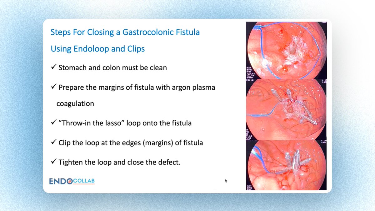 To close a gastrocolonic fistula:
1.Prep fistula margins.
2.Use hemostatic clips, apply zipper technique.
3.Tighten loop with detachable ligatures on gastric side.