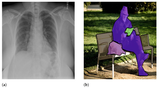 Applsci's tweet image. 🔥 Read our paper in the Section &quot;Electrical, Electronics and Communications Engineering&quot;
📚ACapMed: Automatic Captioning for Medical Imaging
🔗mdpi.com/2076-3417/12/2…
👨‍🔬 by Dr. Djamila Romaissa Beddiar et al.   
#imagecaptioning #medicalimages