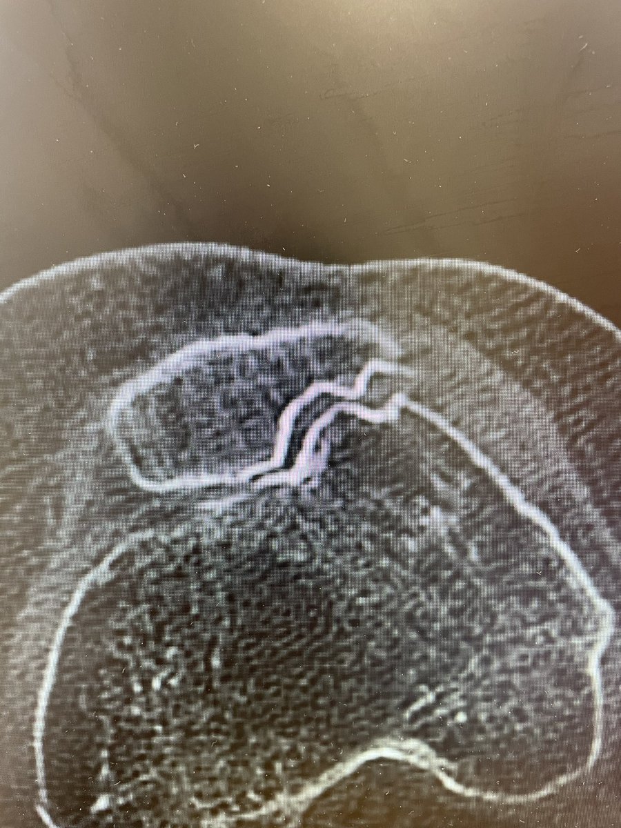 This type of patellofemoral arthritis always reminds me of a crinkle cut crisp!