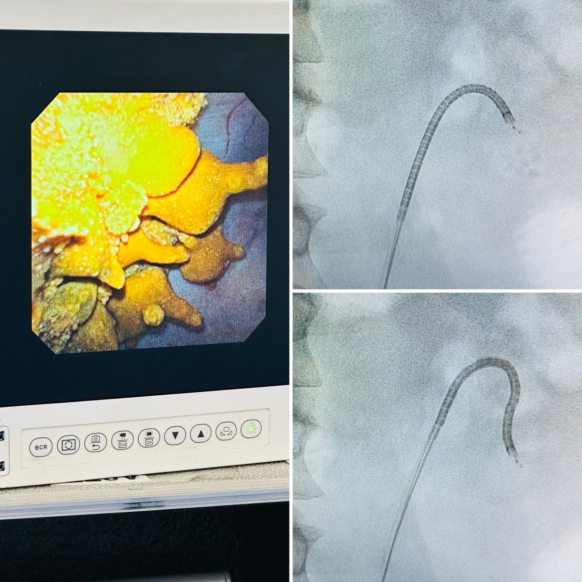 leogomeslopes's tweet image. New chapter of DUST and SUCTION: #DISS

My first try with this combination: @DornierMedTech    and direct scope suction

🎆Dusting mode: 300mJ 75Hz (22.5w)

Waiting feedback from DISS masters: @DocGauhar @DrParimalGharia @TFL_URO_APIS @sbinhamrii @migokce @ytanidir