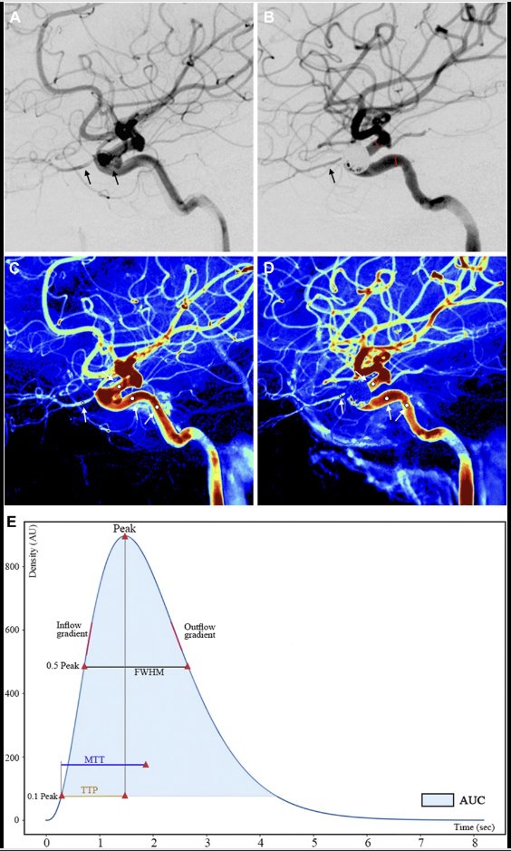 Neurosurgery Publications (@neurosurgerycns) on Twitter photo #NEUNew Quantitative Analysis of Hemodynamic Changes in Branch Arteries Covered by Flow Diverters bit.ly/3V1hO0f by You et al Beijing Tiantan Hospital and Beijing Neurosurgical Institute <a href="/jmascite/">Justin R. Mascitelli, MD, FAANS</a> <a href="/CNS_Update/">CNS</a> <a href="/LKReedMD/">Laura K. Reed, MD</a> <a href="/george_maragkos/">George Maragkos, MD</a> <a href="/Zaazoue/">Mohamed Zaazoue</a> <a href="/urquiagajf_MD/">Jorge F. Urquiaga</a> <a href="/e_celano/">Emma Celano</a> #NEUNew Quantitative Analysis of Hemodynamic Changes in Branch Arteries Covered by Flow Diverters bit.ly/3V1hO0f by You et al Beijing Tiantan Hospital and Beijing Neurosurgical Institute <a href="/jmascite/">Justin R. Mascitelli, MD, FAANS</a> <a href="/CNS_Update/">CNS</a> <a href="/LKReedMD/">Laura K. Reed, MD</a> <a href="/george_maragkos/">George Maragkos, MD</a> <a href="/Zaazoue/">Mohamed Zaazoue</a> <a href="/urquiagajf_MD/">Jorge F. Urquiaga</a> <a href="/e_celano/">Emma Celano</a>
