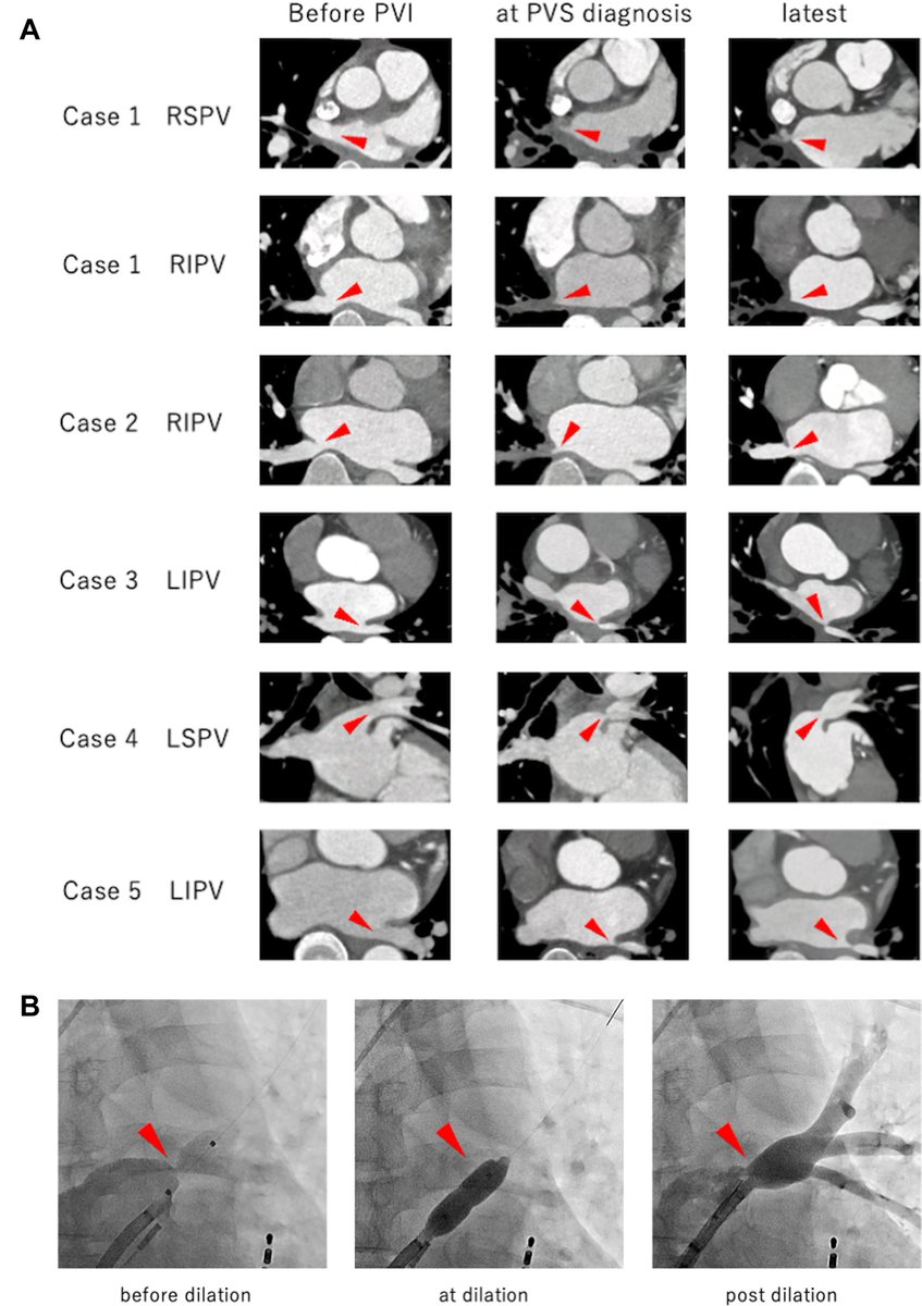 Long-term outcome of repeat balloon angioplasty for pulmonary vein stenosis after radiofrequency ablation: A case series 
heartrhythmcasereports.com/article/S2214-…