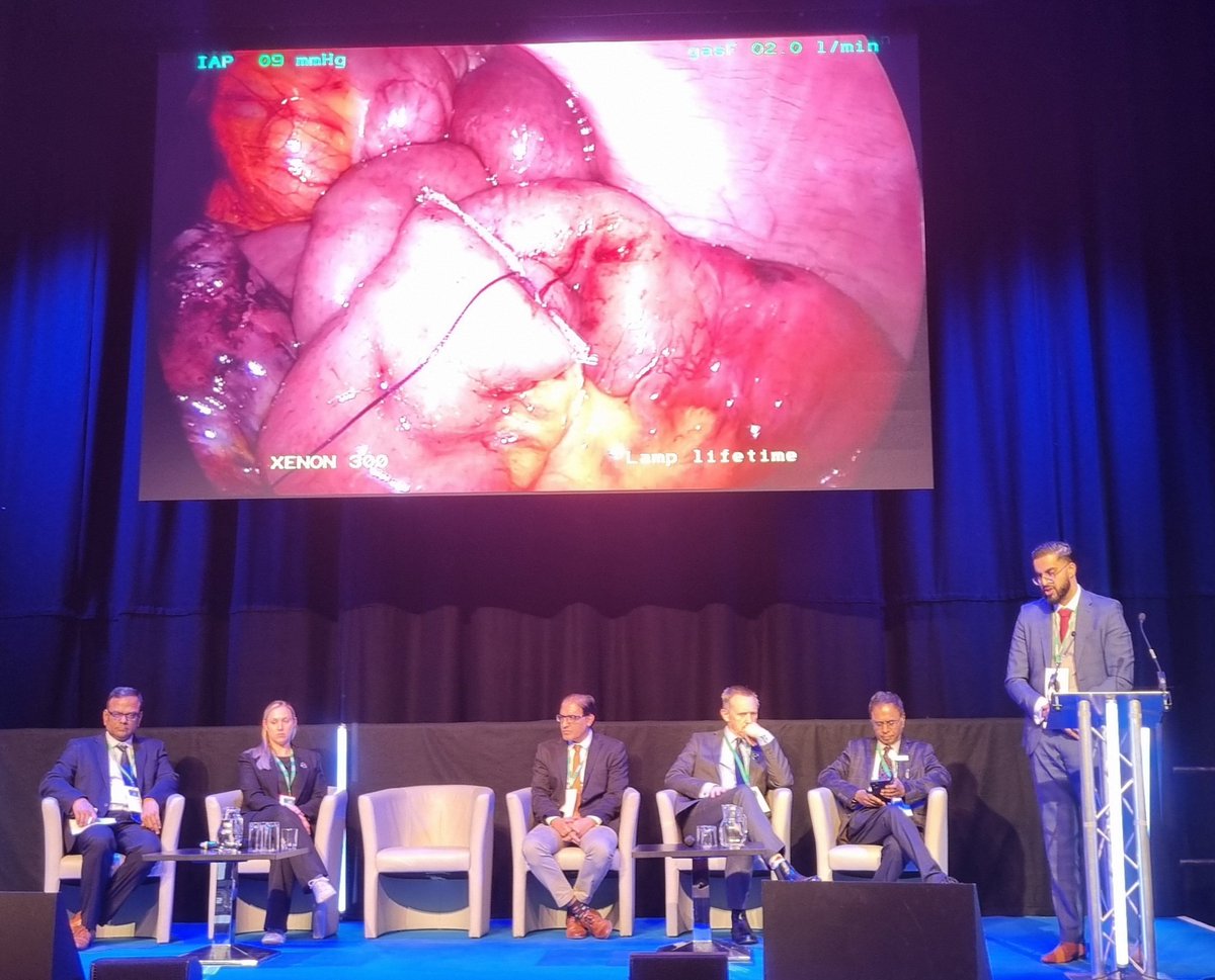 Fantastic video case presentations from <a href="/drjag2221/">Jamil Ahmed Gorsi</a> on MIS in Emergency colorectal surgery and <a href="/javlatif/">Javed Latif</a> on jejuno-jejunal intussuception post gastric bypass in a pregnant patient. Beautifully demonstrated laparoscopic and robotic techniques! #ALSGBIASM2024