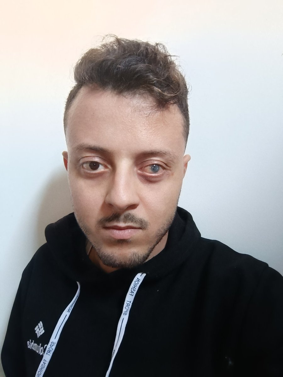 My Eye Still Hurts Me, and I Still Alive.

If u Cares, Please Pray for me. 

gofund.me/e72769fc