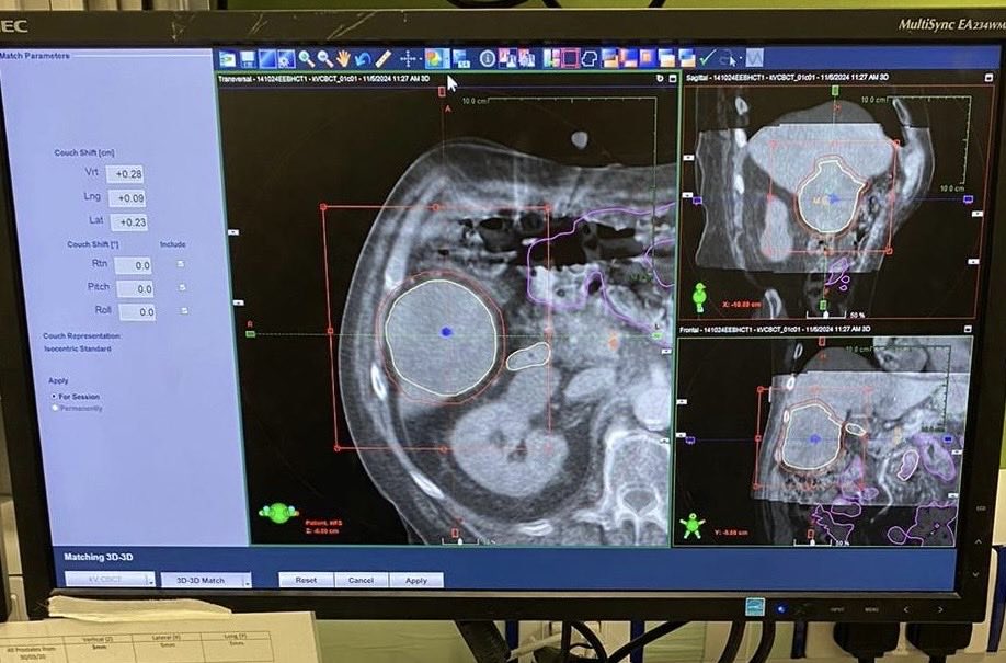 Charles Gillham MD (@charles_gillham) on Twitter photo Another great day for the St Luke’s Radiation Oncology Network as the first patient is treated with liver SABR. A truly multidisciplinary venture and dedicated team. Congratulations 🙌 <a href="/hseNCCP/">NCCP</a> <a href="/HSEDubMidlands/">HSE Dublin and Midlands</a> <a href="/HSELive/">HSE Ireland</a> <a href="/IrishCancerSoc/">Irish Cancer Society</a> Another great day for the St Luke’s Radiation Oncology Network as the first patient is treated with liver SABR. A truly multidisciplinary venture and dedicated team. Congratulations 🙌 <a href="/hseNCCP/">NCCP</a> <a href="/HSEDubMidlands/">HSE Dublin and Midlands</a> <a href="/HSELive/">HSE Ireland</a> <a href="/IrishCancerSoc/">Irish Cancer Society</a>