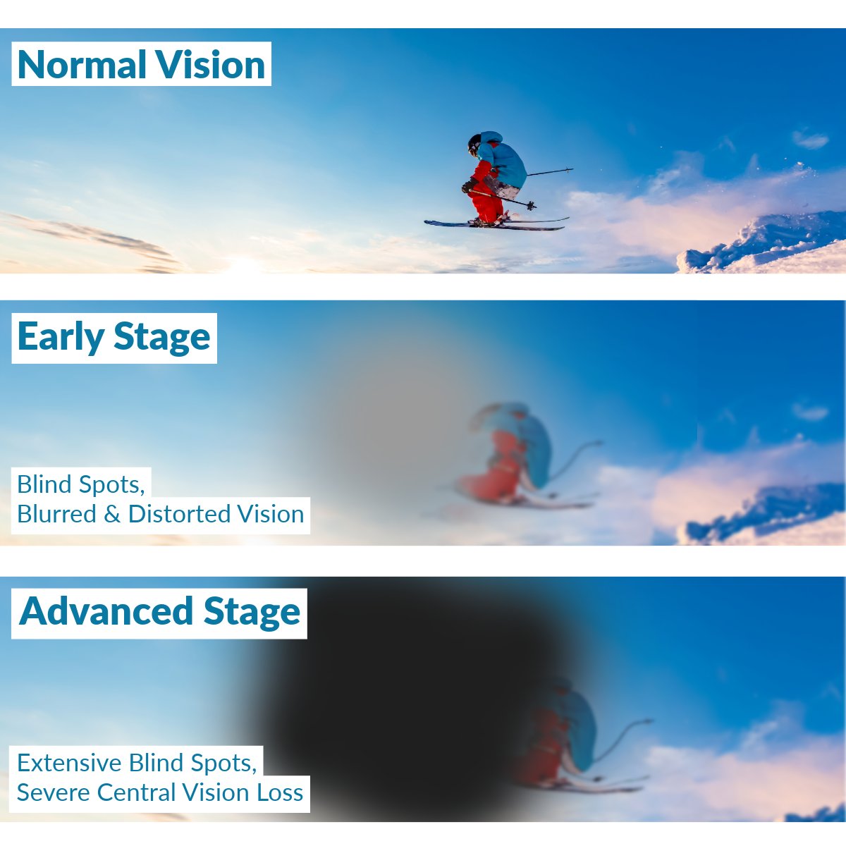 Stargardt's disease affects central vision, causing blurred and distorted images along with blind spots that grow over time. Swipe to see a comparison of how vision changes from early to advanced stages. 
#StargardtsDisease #LowVisionAwareness #LowVision
