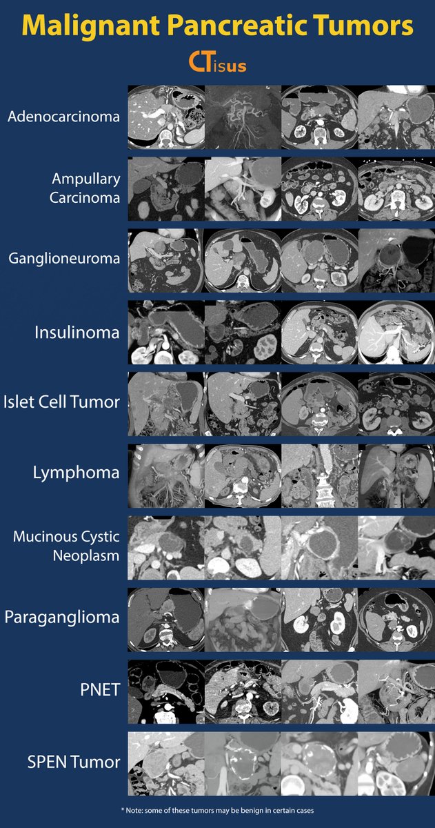 ctisus's tweet photo. Malignant Pancreatic Tumors

Read more here: https://t.co/aw0fGaYsh5 https://t.co/ooIUu9I4Pf