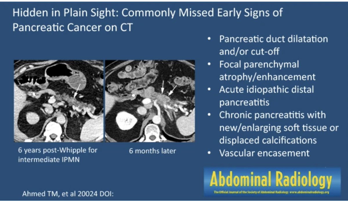 Abdominal Radiology (@abdominal_rad) on Twitter photo Hidden in plain sight: commonly missed early signs of pancreatic cancer on CT
Taha Ahmed et al
link.springer.com/article/10.100…
#AbdRadJ
<a href="/RadGeek/">Neeraj Lalwani</a>
@bobmarks76
<a href="/LetDdiceFlyHigh/">Sandeep Arora</a> Hidden in plain sight: commonly missed early signs of pancreatic cancer on CT
Taha Ahmed et al
link.springer.com/article/10.100…
#AbdRadJ
<a href="/RadGeek/">Neeraj Lalwani</a>
@bobmarks76
<a href="/LetDdiceFlyHigh/">Sandeep Arora</a>