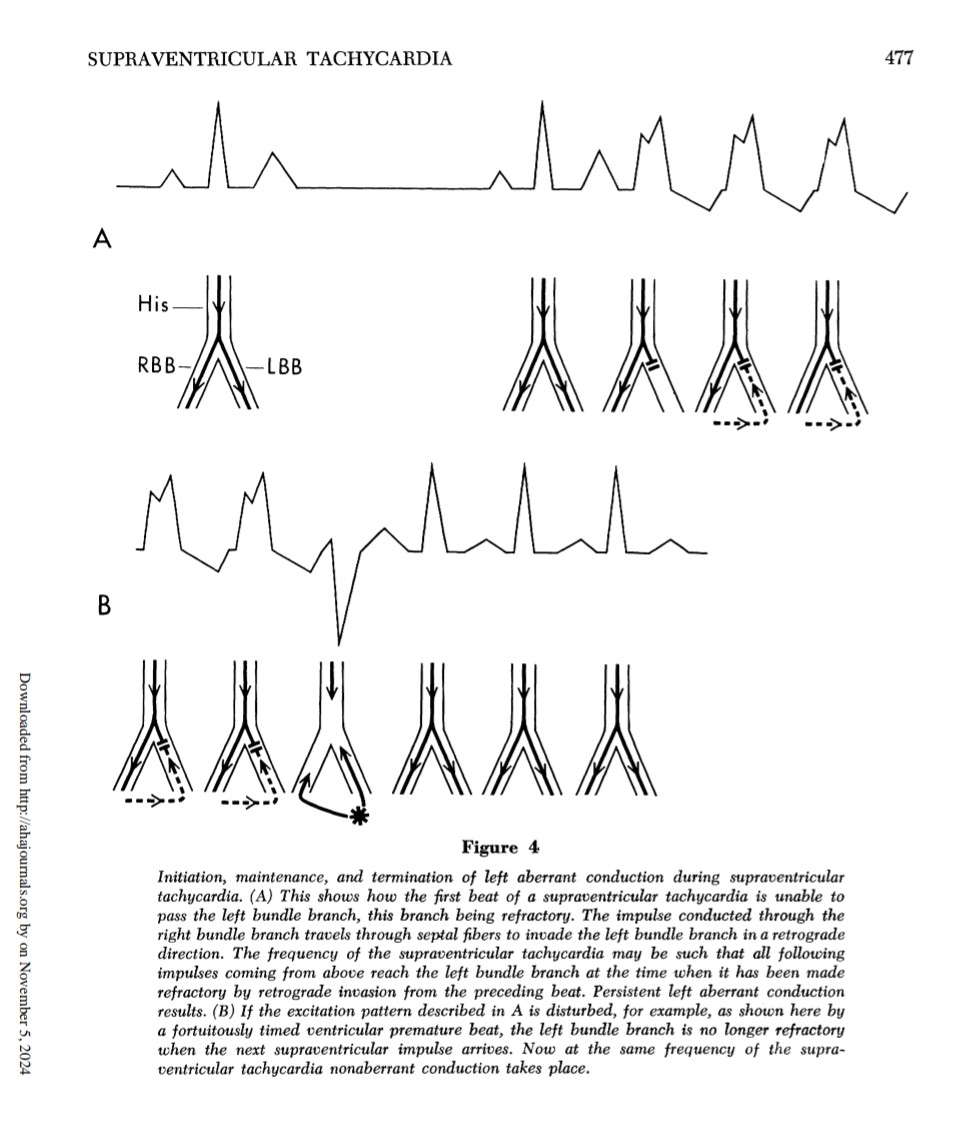 Milan Koštek (@kostekmilan) on Twitter photo <a href="/FergieLosiniec1/">Fergie J. Losiniecki, MD, FACC, FHRS</a> <a href="/Medtronic/">Medtronic</a> Here transseptal conduction keeps LBBB until VE resets both bundles and since there's no delay in both bundles you have no bundle branch block. Maybe CSP is now trendy. The same can be achieved by LBBB area pacing. With some small delay but eliminating LBBB with LV dysfunction. <a href="/FergieLosiniec1/">Fergie J. Losiniecki, MD, FACC, FHRS</a> <a href="/Medtronic/">Medtronic</a> Here transseptal conduction keeps LBBB until VE resets both bundles and since there's no delay in both bundles you have no bundle branch block. Maybe CSP is now trendy. The same can be achieved by LBBB area pacing. With some small delay but eliminating LBBB with LV dysfunction.