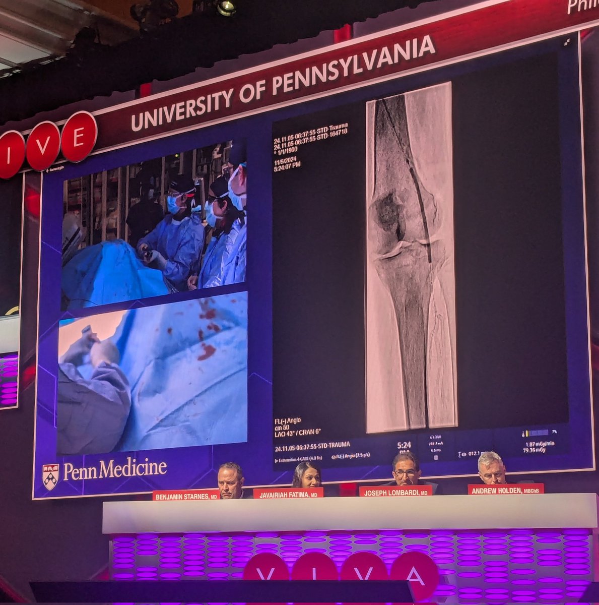 Vascular News (@vascularnews) on Twitter photo #VIVA24: Liz Genovese performs a live case involving a patient with CLTI in the popliteal artery and below the knee during <a href="/VIVAPhysicians/">The VIVA Foundation</a>. #VIVA24: Liz Genovese performs a live case involving a patient with CLTI in the popliteal artery and below the knee during <a href="/VIVAPhysicians/">The VIVA Foundation</a>.