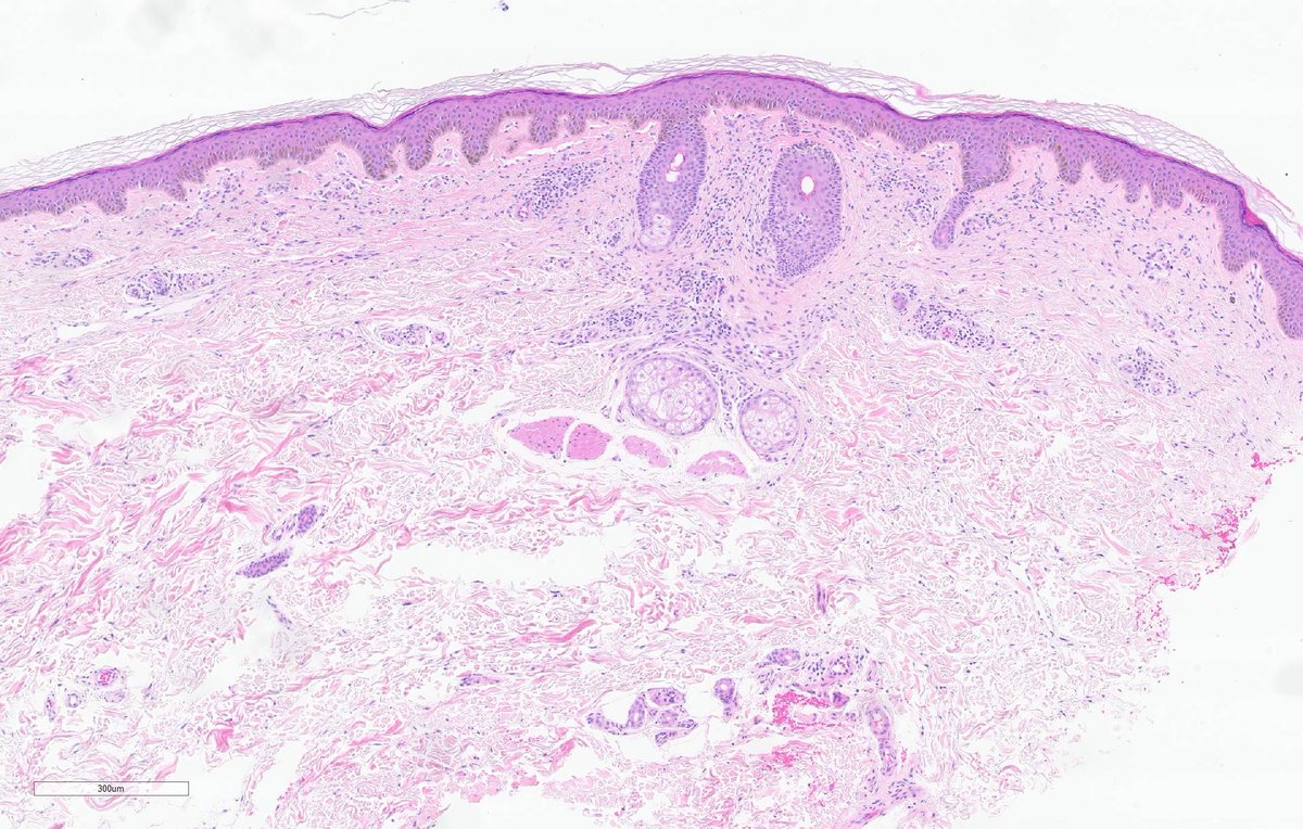 TheJPCNCR's tweet photo. Cutaneous mastocytosis, likely a case of telangiectasia macularis eruptiva perstans.
A 44 yo female presented with a multi-year history of erythematous to light-brown macules distributed throughout the body. #pathtwitter #TheJPCNCR https://t.co/cig8DHylJn