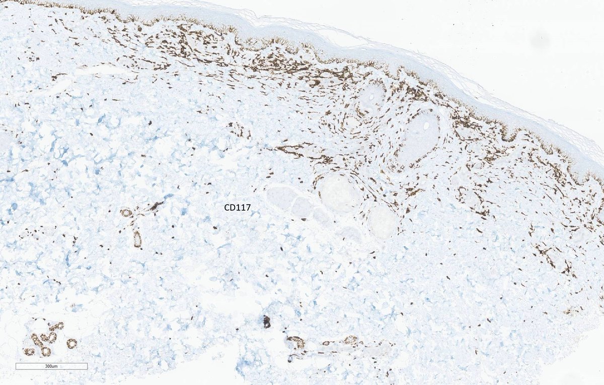TheJPCNCR's tweet photo. Cutaneous mastocytosis, likely a case of telangiectasia macularis eruptiva perstans.
A 44 yo female presented with a multi-year history of erythematous to light-brown macules distributed throughout the body. #pathtwitter #TheJPCNCR https://t.co/cig8DHylJn