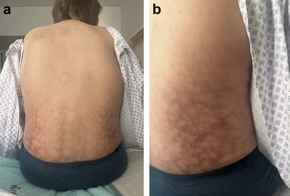 Kidney International (@kidney_int) on Twitter photo Kidney failure and a reticulated dermatosis
doi.org/10.1016/j.kint…
<a href="/ChariteBerlin/">Charité - Universitätsmedizin Berlin</a>
#KINephrologyImage #kidneyfailure #AKI #diabeticnephropathy Kidney failure and a reticulated dermatosis
doi.org/10.1016/j.kint…
<a href="/ChariteBerlin/">Charité - Universitätsmedizin Berlin</a>
#KINephrologyImage #kidneyfailure #AKI #diabeticnephropathy