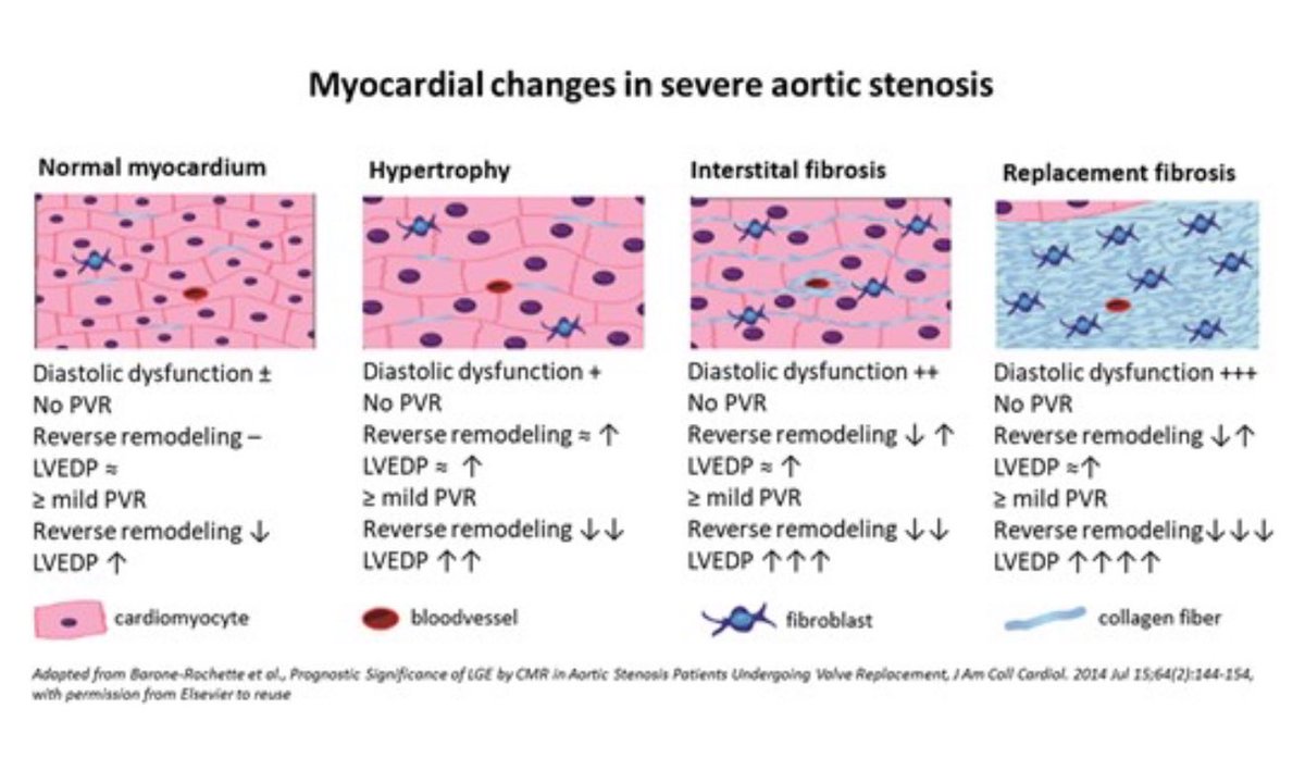 EHJ-IMP Editor-in-Chief (@ehjimpeic) on Twitter photo 🔥🔥 Most read #EHJIMP 🔥🔥
➡️ How to assess paravalvular leak post #TAVR ?
➡️ academic.oup.com/ehjimp/article…
<a href="/ESC_Journals/">European Society of Cardiology Journals</a> <a href="/alessia_gimelli/">Alessia Gimelli</a> <a href="/BenekiEirini/">Eirini Beneki</a> <a href="/pabloplopez_/">Pablo Pérez López</a> <a href="/saramoscatelli7/">Sara Moscatelli</a> <a href="/BakhshiHooman/">Hooman Bakhshi</a> <a href="/ElenaSurkova9/">Elena Surkova</a> <a href="/JGrapsa/">Julia Grapsa MD, PhD</a> <a href="/ShehabAnwer/">Shehab Anwer, MD</a> <a href="/EZancanaroMD/">Edoardo Zancanaro MD</a> <a href="/EACVIPresident/">EACVI President</a> <a href="/VDelgadoGarcia/">Victoria Delgado</a> 🔥🔥 Most read #EHJIMP 🔥🔥
➡️ How to assess paravalvular leak post #TAVR ?
➡️ academic.oup.com/ehjimp/article…
<a href="/ESC_Journals/">European Society of Cardiology Journals</a> <a href="/alessia_gimelli/">Alessia Gimelli</a> <a href="/BenekiEirini/">Eirini Beneki</a> <a href="/pabloplopez_/">Pablo Pérez López</a> <a href="/saramoscatelli7/">Sara Moscatelli</a> <a href="/BakhshiHooman/">Hooman Bakhshi</a> <a href="/ElenaSurkova9/">Elena Surkova</a> <a href="/JGrapsa/">Julia Grapsa MD, PhD</a> <a href="/ShehabAnwer/">Shehab Anwer, MD</a> <a href="/EZancanaroMD/">Edoardo Zancanaro MD</a> <a href="/EACVIPresident/">EACVI President</a> <a href="/VDelgadoGarcia/">Victoria Delgado</a>
