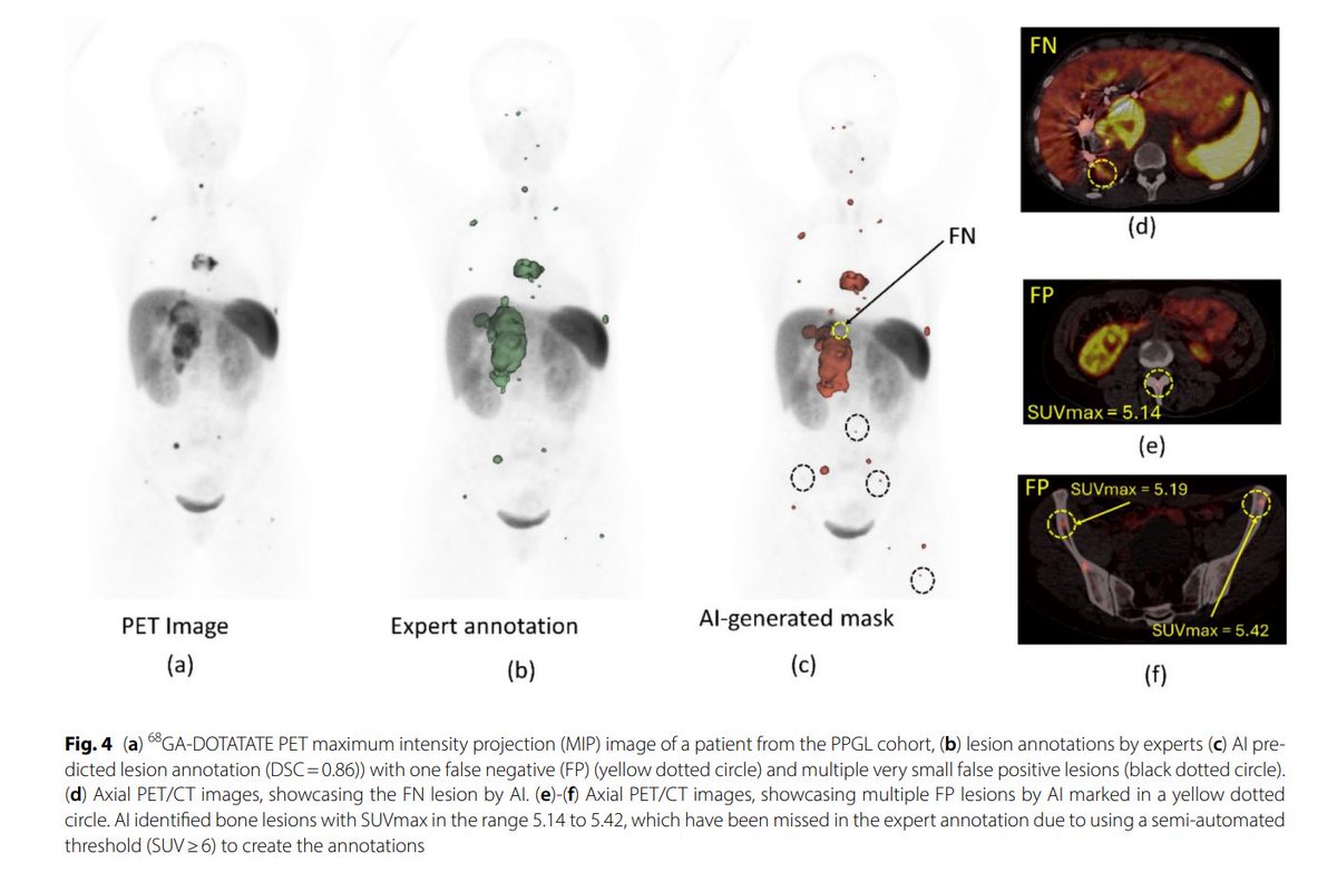 Baris Turkbey MD (@radiolobt) on Twitter photo 📣I am happy to share our new publication "An automated pheochromocytoma and paraganglioma lesion segmentation AI-model at whole-body 68Ga- DOTATATE PET/CT" ejnmmires.springeropen.com/articles/10.11…
👍Congratulations to <a href="/Haque_Fahmida_/">Fahmida Haque</a> <a href="/DrSHarmon/">Stephanie Harmon</a> and our amazing Team and Collaborators 📣I am happy to share our new publication "An automated pheochromocytoma and paraganglioma lesion segmentation AI-model at whole-body 68Ga- DOTATATE PET/CT" ejnmmires.springeropen.com/articles/10.11…
👍Congratulations to <a href="/Haque_Fahmida_/">Fahmida Haque</a> <a href="/DrSHarmon/">Stephanie Harmon</a> and our amazing Team and Collaborators