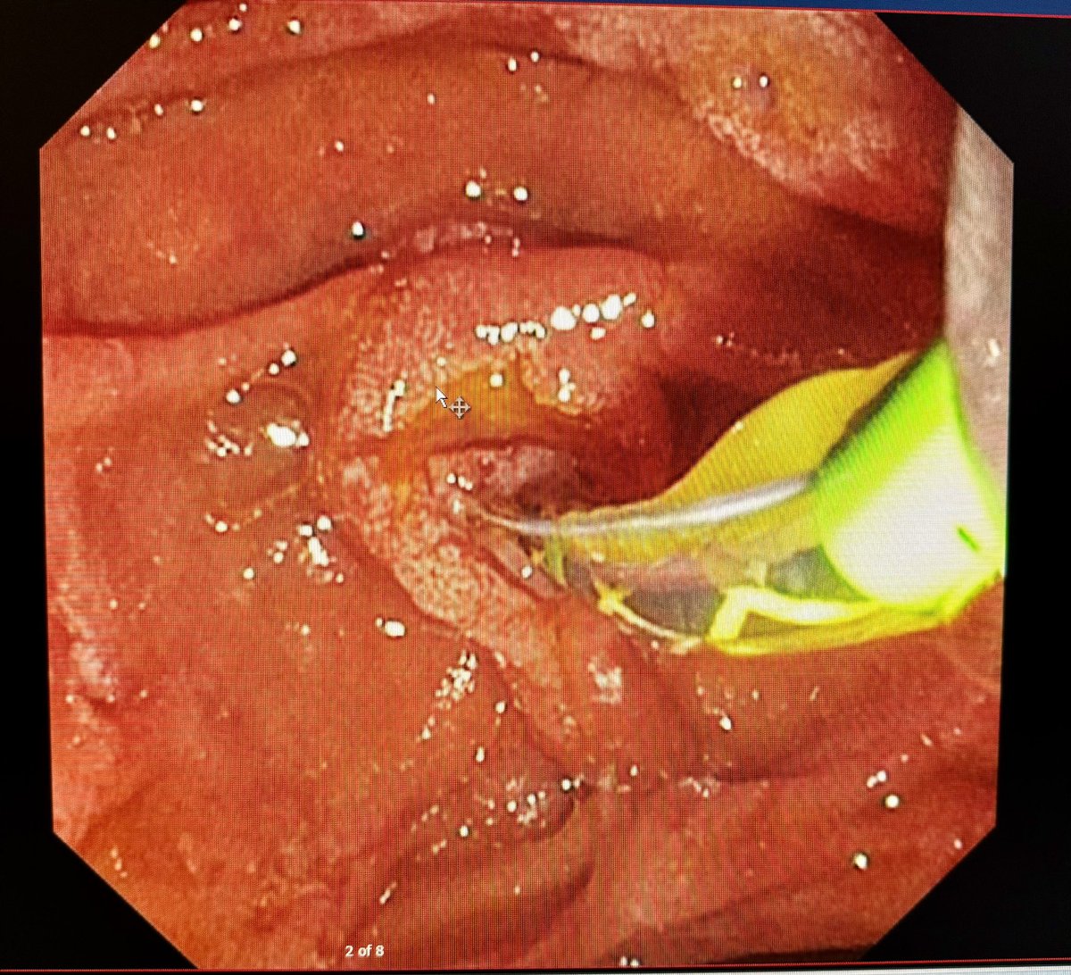Abdul Sattar Shariq Mohammed (@amohammedmd) on Twitter photo When you cannulate your first native papilla! 🤩🥳
Blessed to have a teacher like <a href="/MahamHayatMD/">Maham Hayat, MD</a> When you cannulate your first native papilla! 🤩🥳
Blessed to have a teacher like <a href="/MahamHayatMD/">Maham Hayat, MD</a>