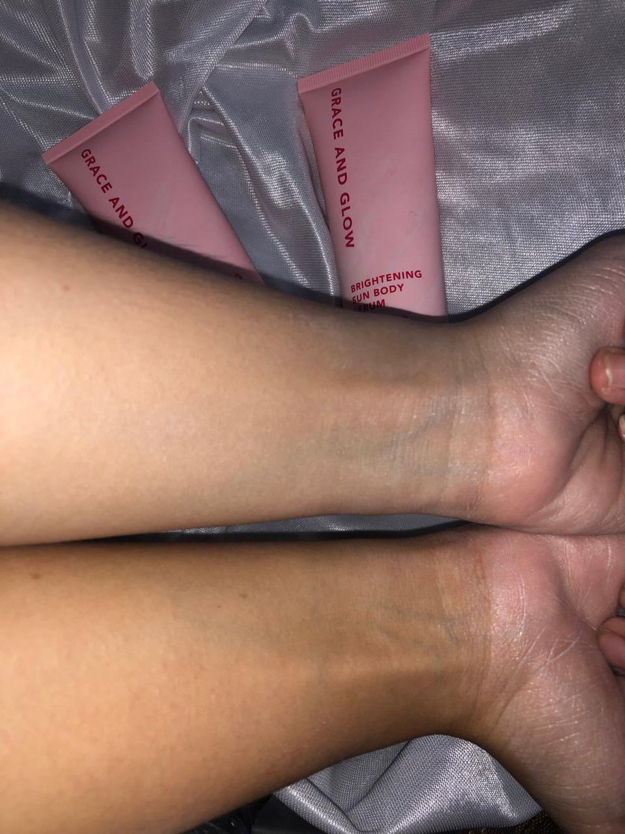 sbeuIgi's tweet photo. udh 2 minggu rutin pake Grace N Glow Body Serum, dan jujur awalnya gak expect apa-apa, tapi hasilnya bikin speechless! Kulitku jadi lebih cerah dan glowing natural, kaya ada efek “no filter” di kehidupan nyata. serumnya super ringan, ga lengket sama sekali! 🧴💫 #ReviewSkincare https://t.co/EBZsPc8Q3C
