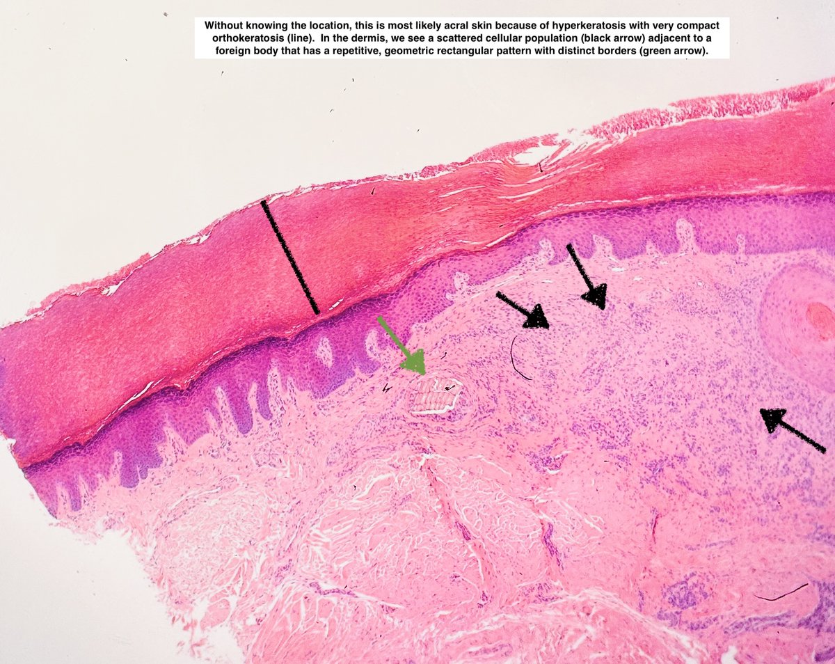 Path4People's tweet image. 🪵 Splinter Granuloma

🔬 Foreign body reaction to microscopic plant material
🦠 Often times has &quot;passenger&quot; fungi 
⚠️ Be concerned when fungi is away from plant material
🔬 ⬇️ 

#pathx #dermpath #fammed #pathology #medicine #medx #histology #splinter