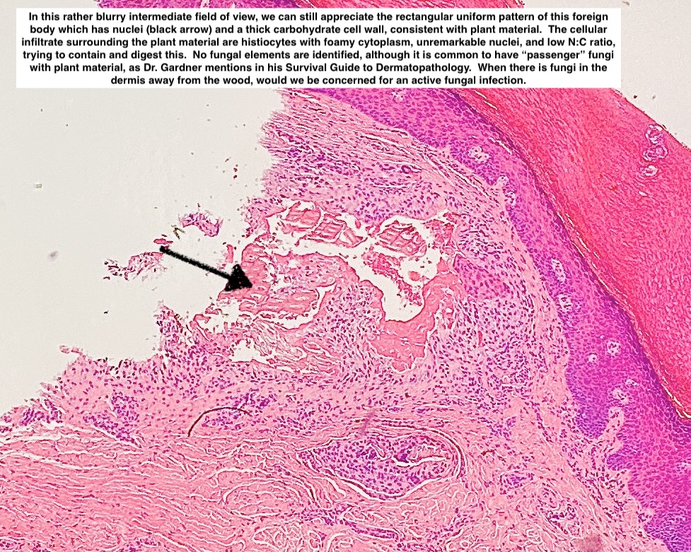 Path4People's tweet image. 🪵 Splinter Granuloma

🔬 Foreign body reaction to microscopic plant material
🦠 Often times has &quot;passenger&quot; fungi 
⚠️ Be concerned when fungi is away from plant material
🔬 ⬇️ 

#pathx #dermpath #fammed #pathology #medicine #medx #histology #splinter