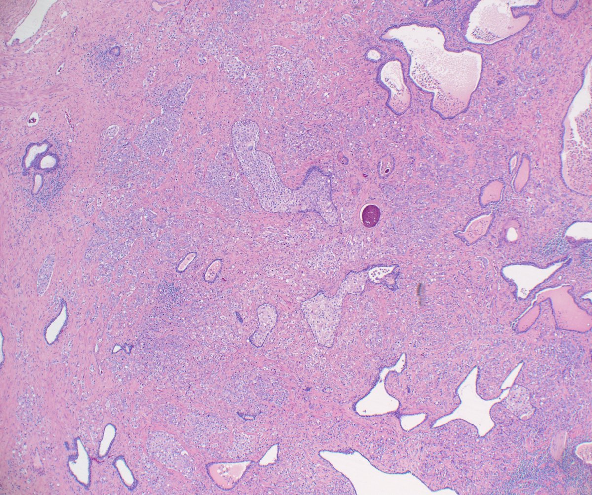 striking "eyeliner" sign of #GUpath prostatic intraductal carcinoma (IDC) in this RP specimen

🚨sometimes, seemingly basal cells by🔬of a putative IDC Dx can in fact be absent by #IHCpath and indicative of invasive tumor (not the case here; PIN4 not done🙃)