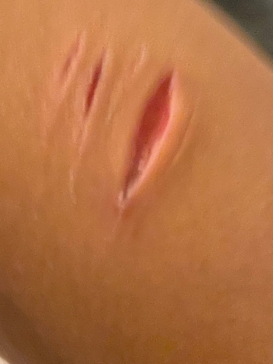 luixiio's tweet photo. i picked off the scab so it would heal better my aftercare is soo good 😻😻 https://t.co/1fyhmZBIM8