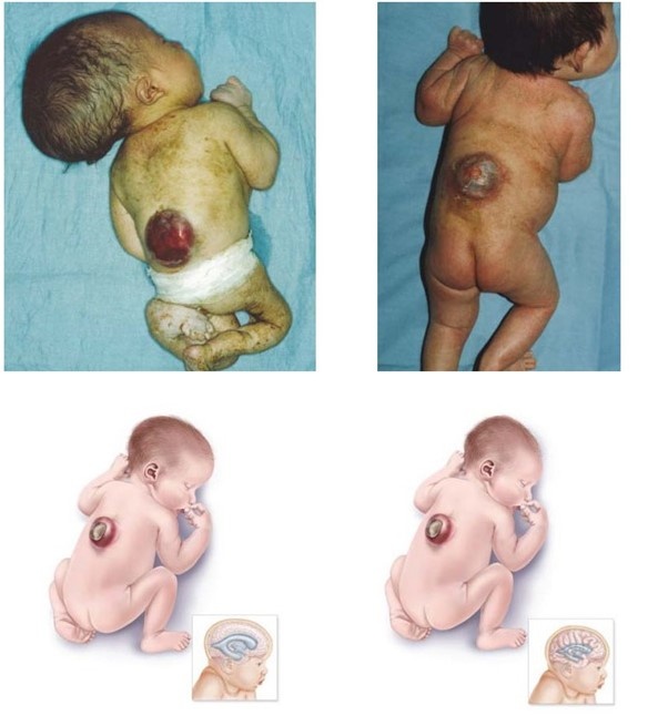 Gazal6849's tweet photo. 🔴Med Quiz 

Which anti-seizure medication, is contraindicated in pregnancy due to a high risk of neural tube defects❓

A) Lamotrigine
B) Carbamazepine
C) Valproate
D) Phenytoin

#medx https://t.co/FaqmJ6FmG4