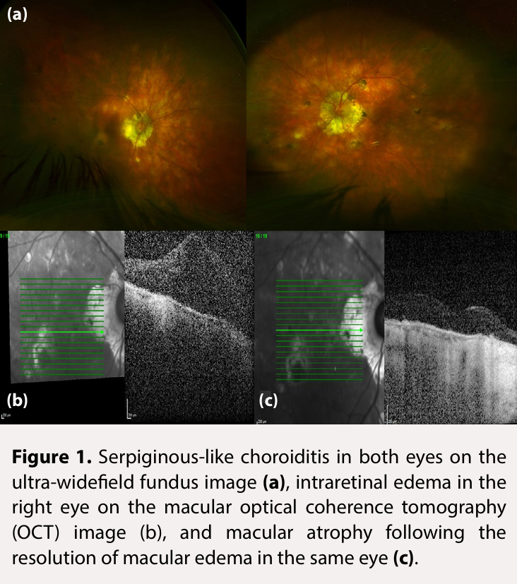 JClinPractRes's tweet photo. Ocular Tuberculosis, Anti-Tuberculosis Prophylaxis, and  Diseases Confused with Ocular Tuberculosis: Brief Report

https://t.co/wF3qjTTtQi

#tuberculosis  #FOAMed #FOAM #MedTwitter #MedEducation #medicaljournal #JClinPractRes https://t.co/JdzRhNi9ki