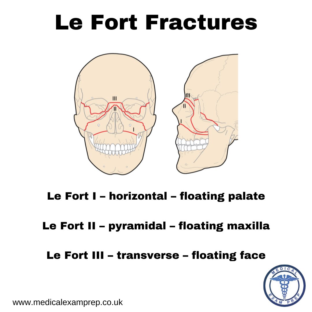 MedicalExamPrep's tweet photo. It can be challenging to memorise the three Le Fort injury patterns; however, the following aide-mémoire can be helpful. #FOAMed #MedEd #MaxFax #MRCEM https://t.co/aW8tdxFouz