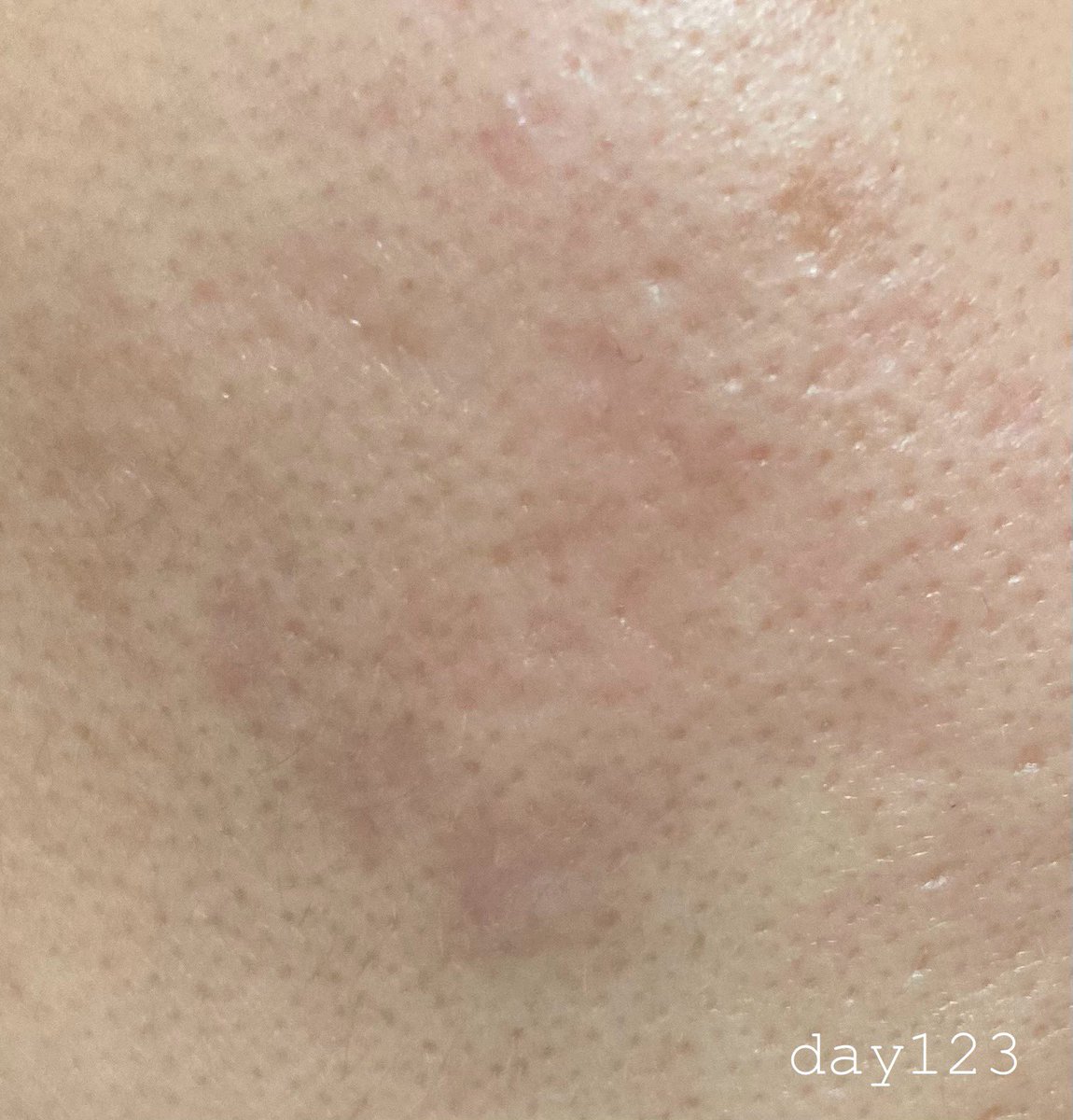 peace_ohada's tweet image. 皮膚科でエクラーブラスターについて聞いたところケロイド用なのでしこりには貼らないように言われました🥲しこりは先週WINBACKを受けてから小さくなりました！5mmと1cmのしこりがあって小さい方はなくなりました！#サブシジョン #しこり　#WINBACK #ララピール