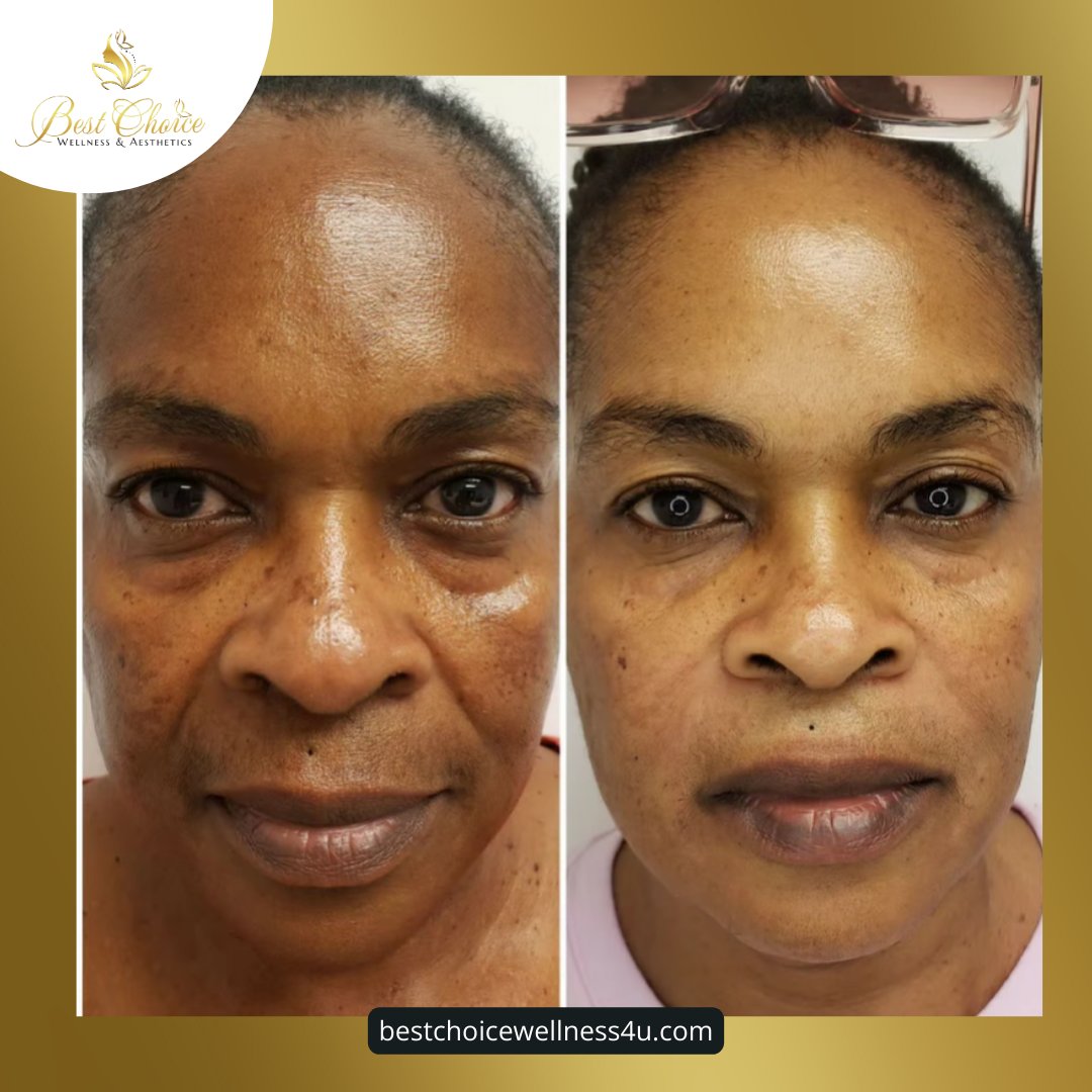 BWellness4u's tweet photo. Check out this incredible before and after of our PDO Thread Lift treatment! ✨

With minimal downtime and amazing results, PDO Thread Lifts lift and tighten the skin, giving you a refreshed, youthful appearance.

Ready to rejuvenate your skin and turn back the clock? https://t.co/E1olGw1CyA