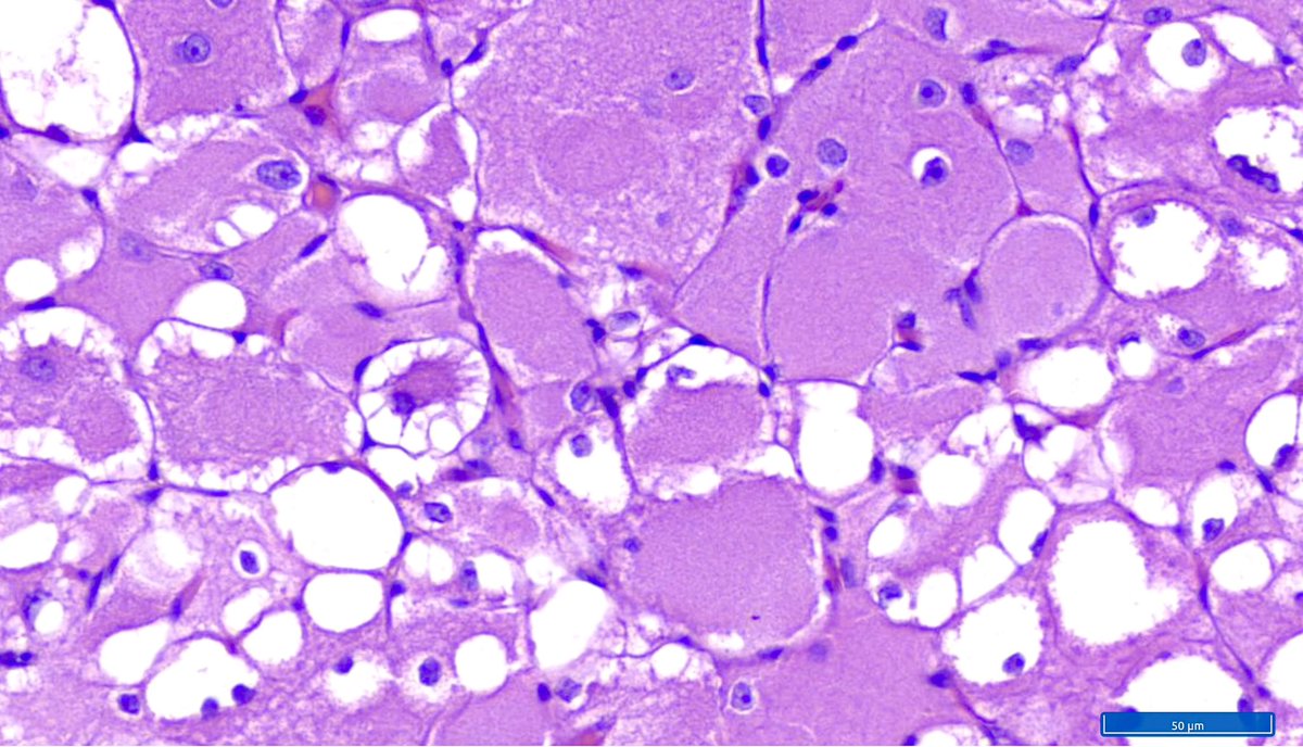 Hashimoto__0's tweet photo. Mass in the floor of the oral cavity 

Your diagnosis?
Positive stains?
Associated syndrome? https://t.co/KR6OhpMXbJ