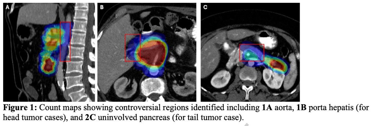 🔥<a href="/NRGonc/">NRG Oncology</a> dose escalated #radonc contouring atlas for inoperable #pancreaticcancer in press!🔥
➡️Step-by-step recs for anatomically derived CTV 
➡️Dose escalation strategies suggested
➡️Will be reference for upcoming ph3 NRG GI011 trial that requires CTV

redjournal.org/article/S0360-…