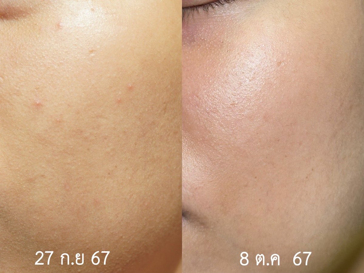 wi_wireviews's tweet image. กลับจากทะเลมา สิวก็โผล่มาเลยจ้าาา ขึ้นอะไรไม่ขึ้น ขึ้นตรงหน้าแก้ม แล้วไอ้เราก็ชอบแกะซะด้วยไง ต้องขอกราบ Eucerin ที่ขึ้นชื่อเรื่องกำจัดสิวโดยเฉพาะ Eucerin Triple Effect Serum และ Eucerin Gel to Foam Cleanser ที่จบทุกสิวและรอยสิวซ้ำซาก ไม่ว่าจะสิวและรอยสิวแบบไหน ผิวมันยังไง…